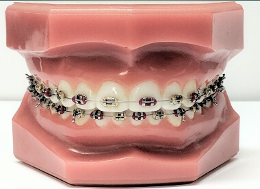  Braces and Aligners